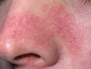 Rash on Nose, around Mouth, Upper Lips, Dry Skin, Causes, Won’t Go Away ...