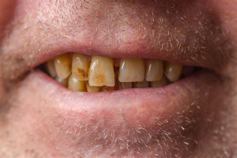 Smokers Teeth Before And After