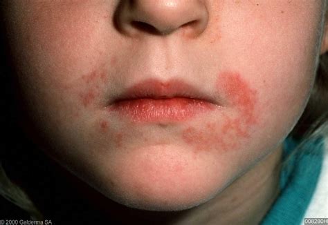 Dermatitis Rash On Face