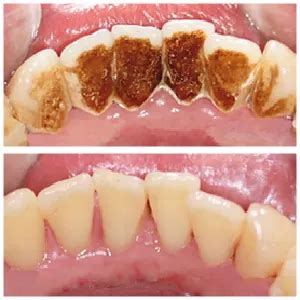 Teeth Scaling & Polishing: Cost & Treatment by Hash Dental Clinic