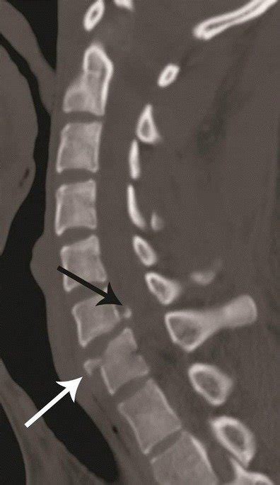 Avulsion fracture in hyperextension dislocation. Sagittal CT image... | Download Scientific Diagram