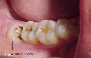 What is the Reason For Wisdom Teeth Removal | All Smiles Dental Spa