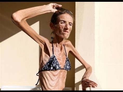 Skinniest Person In The World- 55 lbs - YouTube