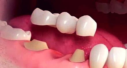 Dental Bridges, a Complete Overview
