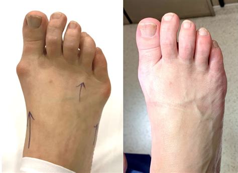 Tailors Bunion Surgery Before And After