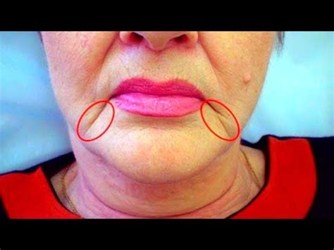 Marionette Lines ? | How To Get Rid of Marionette lines And Lift Up Lips Corners With Massage ...