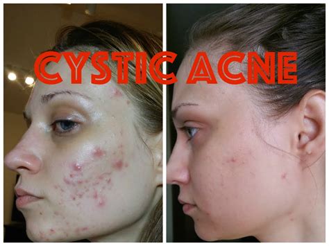 Cystic Acne Scars