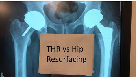 Difference Between Hip Resurfacing And Total Hip Replacement