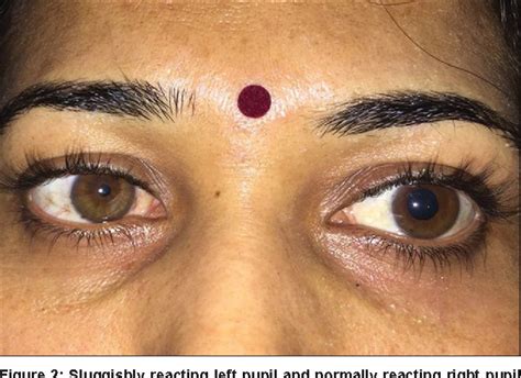 Figure 1 from A Rare Case of Ross Syndrome | Semantic Scholar