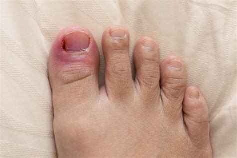 How To Fix A Ingrown Nail - Matthews Shomire