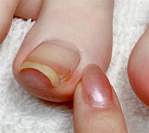 Ingrown Toenails — Meticulous Manicurist