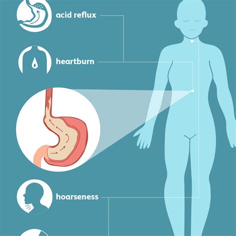 GERD: Signs, Symptoms, and Complications