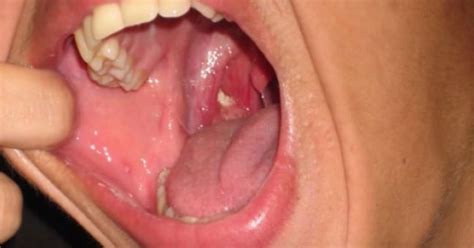 Woman's Tonsil Stones Lead To Chronic Bad Breath