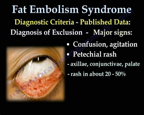 Fat Embolism Syndrome