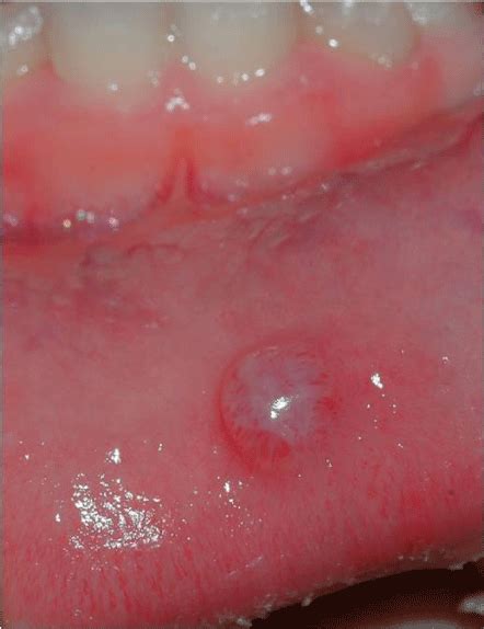 Mucous Cyst Lip