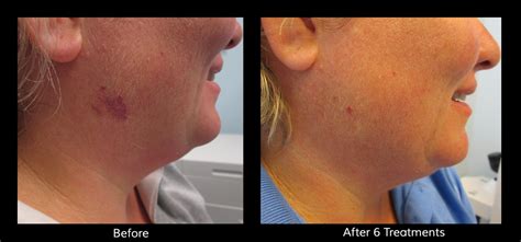 Laser Birthmark Removal: Remove Birthmarks, Port Wine Stains - Connecticut Skin Institute