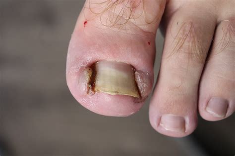 Brittle Toenails In Toddlers at Amy Ford blog