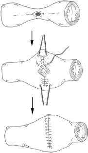 A Comprehensive Review of Strictureplasty Techniques in Crohn’s Disease ...