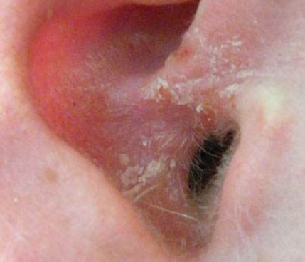 Dry Skin in Ears, Inside Ear Canal, Itchy, Flaky Skin Behind Ears, Inside, Around, Treatment ...