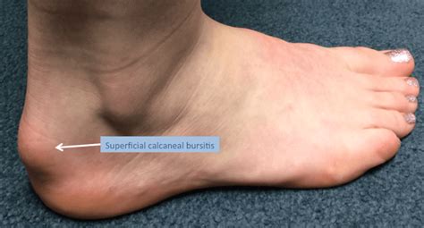 Subcutaneous Calcaneal Bursitis