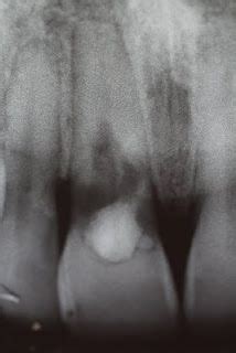 External root resorption | Dental, Dental hygiene, Dentistry