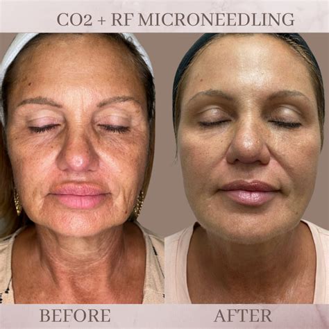 CO2 Resurfacing - Eluma - Laser & Aesthetics