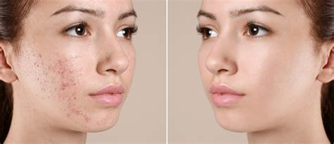 141,118 Acne Face Images, Stock Photos, 3D objects, & Vectors | Shutterstock