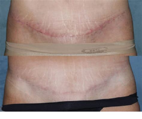 Figure 1 from Laser Treatment of Scars | Semantic Scholar