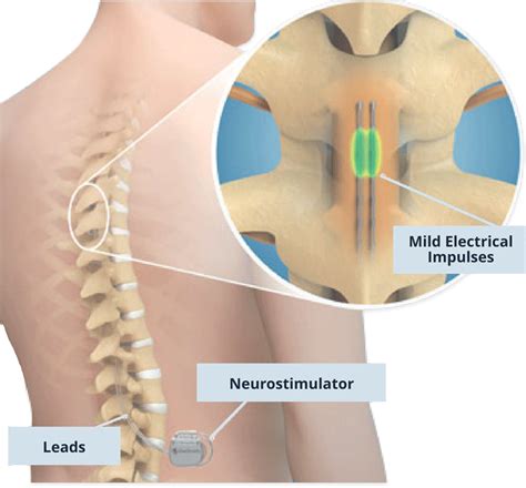 Spinal Column and Peripheral Nerve Stimulator - Back Pain Treatment