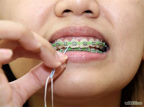 If you have trouble flossing with braces, try using a floss threader ...