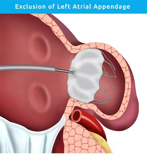 Exclusion of Left Atrial Appendage | Professor Kevin P Walsh