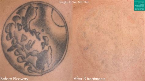 Laser Tattoo Removal Medical Spa | San Diego, CA | CLDerm