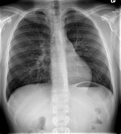 Tracheal and endobronchial lesions | Radiology Reference Article | Radiopaedia.org