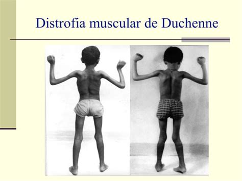 O que é Distrofia Muscular de Duchenne, Tratamento, Tem Cura?