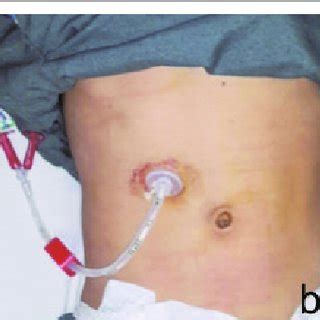 a: Endoscopic view, showing PEG tube in stomach. b: PEG tube placed on... | Download Scientific ...