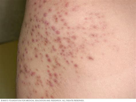 Folliculitis - Symptoms and causes (2022)