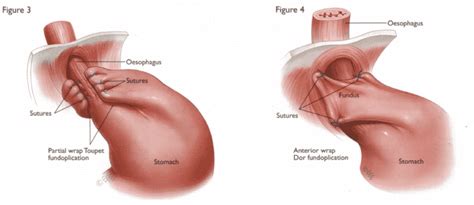 Dor Fundoplication