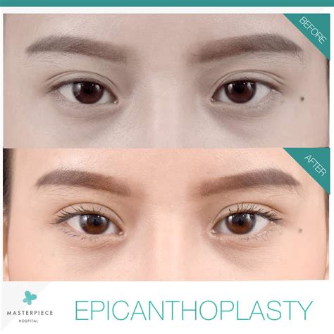 Epicanthal Folds Surgery / 15 Epicanthoplasty and Aesthetic Lateral ...