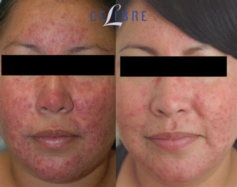 Laser Treatment For Rosacea: Types, Efficacy, Side Effects,, 47% OFF