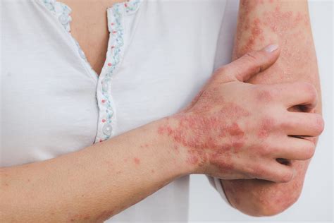 How To Treat Psoriasis | Skin And Cancer Institute - Blog