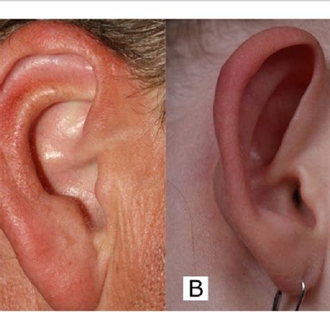 (PDF) Release of the Inferior Crus in Antihelix Plasty