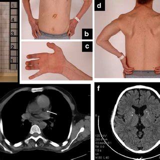 Clinical findings in children with nephropathic cystinosis | Download Table