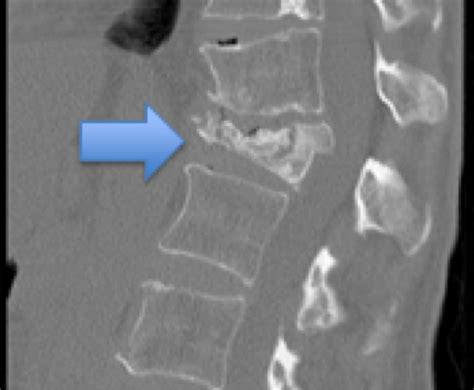 [DIAGRAM] Diagram Of Vertebral Fracture - MYDIAGRAM.ONLINE