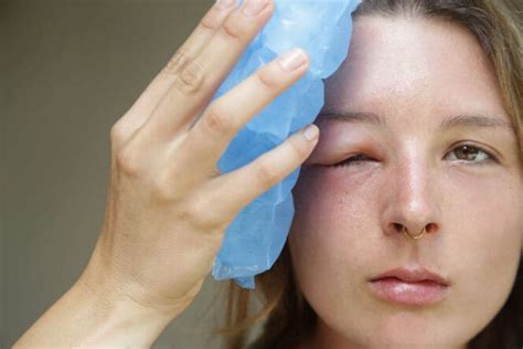 Swollen Eyelids: Causes & Treatment | MyVision.org