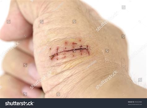 Closeup Hand Wound Stitches Stock Photo 99264980 - Shutterstock