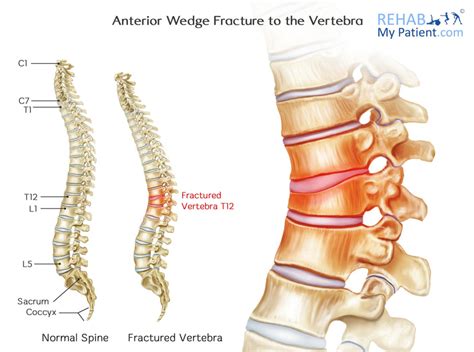 Anterior Wedge Fracture to the Vertebra | Rehab My Patient