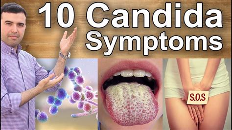 Signs And Symptoms Of Candidiasis Download Scientific - vrogue.co