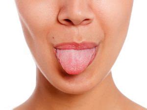 All you need to know about tongue fungus · Gross Dentist