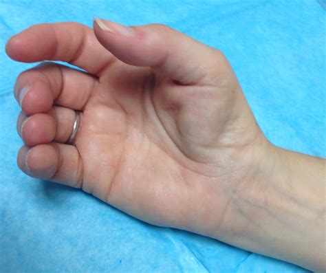 Thenar Muscle Atrophy | Hand Surgery Source