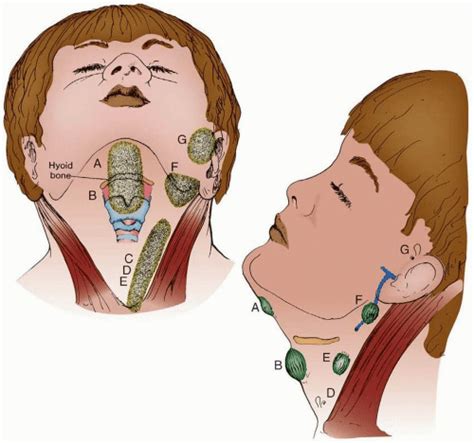 Congenital Thyroglossal Duct Cyst | Images and Photos finder